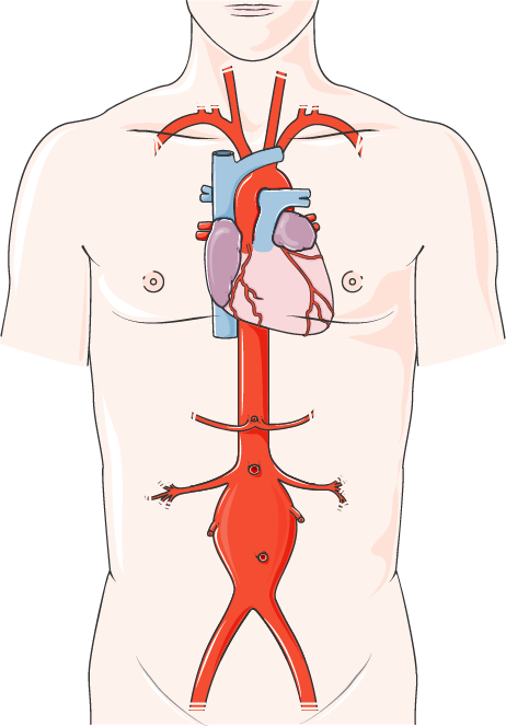 Anevrisme de l'aorte abdominal