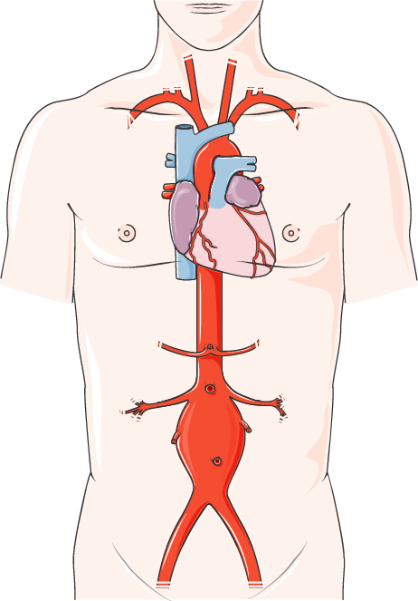 Artériopathie obstructive