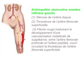 Artériopathie obstructive