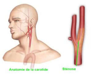 Anevrisme de l'aorte abdominal