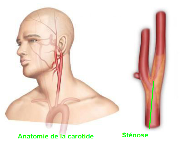 Sténose carotidienne